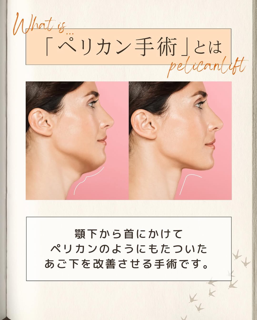 ペリカンリフトとは｜あご下・二重顎のたるみを複合的に改善する手術の仕組みと適応 画像2