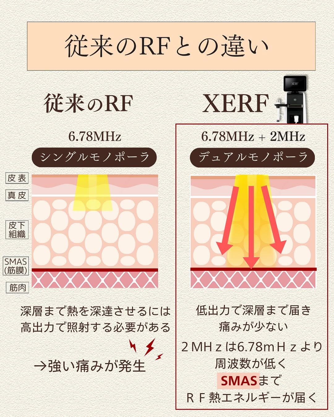 ザーフ（XERF）直後のフェイスラインのピタッとした引き締め効果を実感した症例 画像2