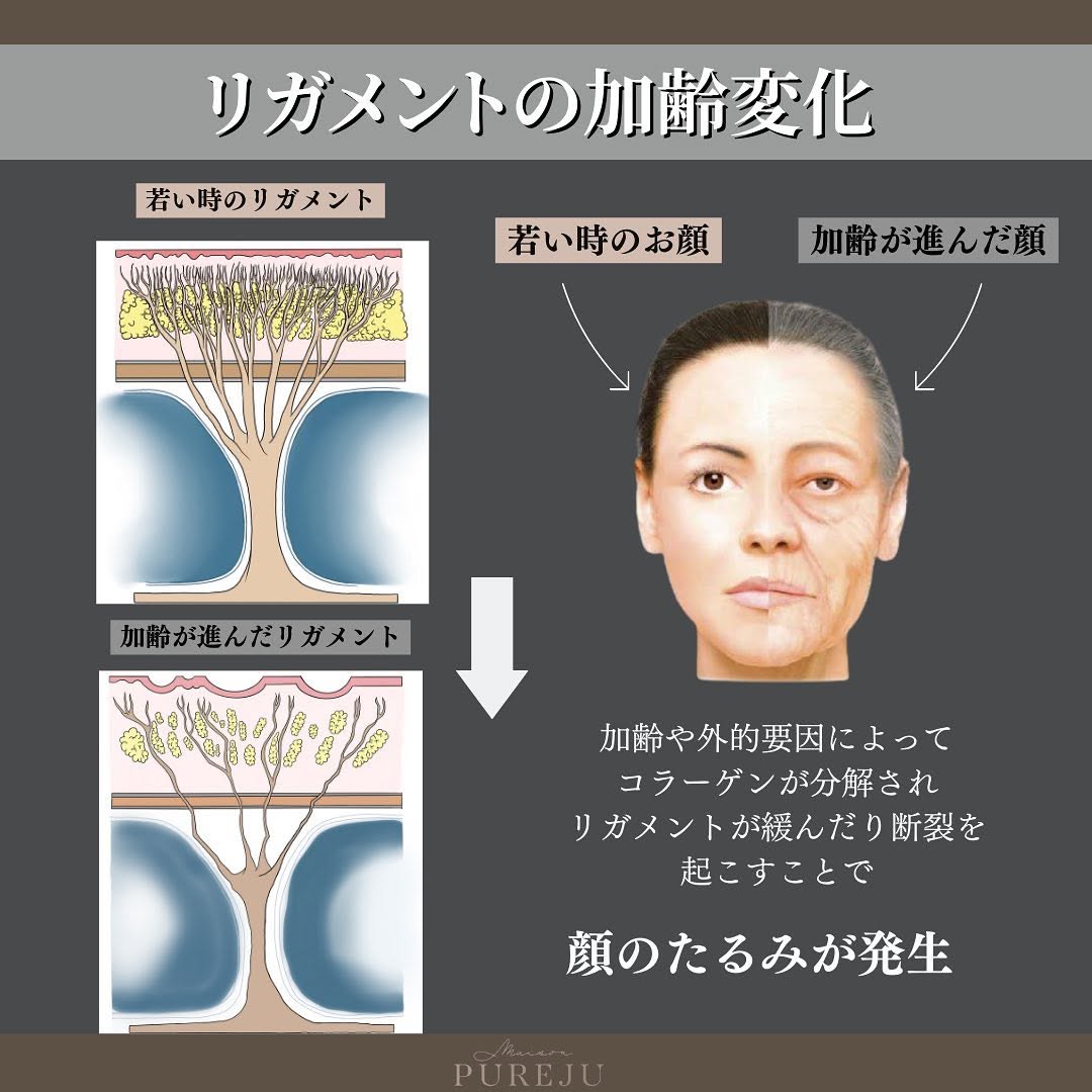 ジャルプロスーパーハイドロとは｜リガメントを強化してたるみ・ハリを根本から改善する注入治療 画像4