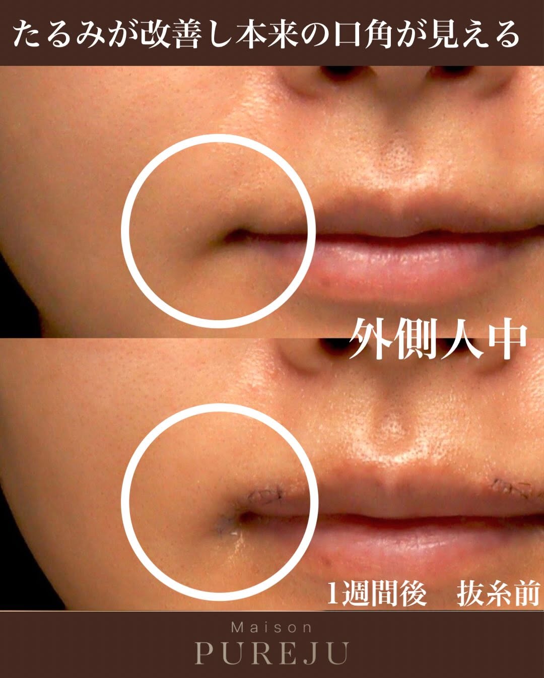 外側人中手術で唇のバランスを立体的に改善し口元の印象を整えた症例 画像3