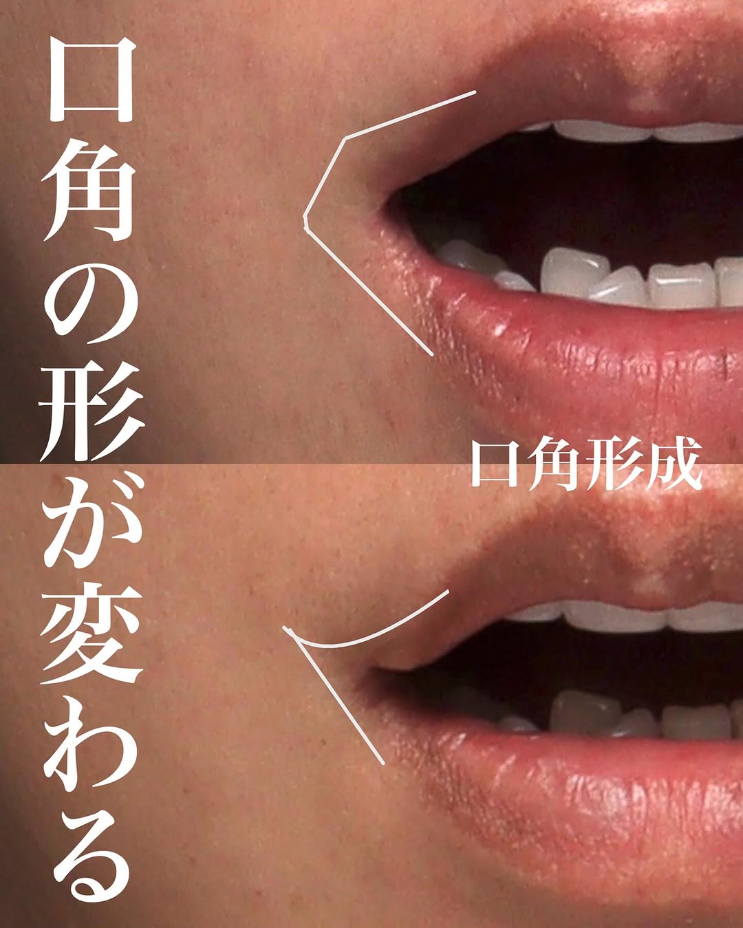 口角挙上術後1年の長期経過で笑いやすさ・しゃべりやすさも維持している症例 画像3