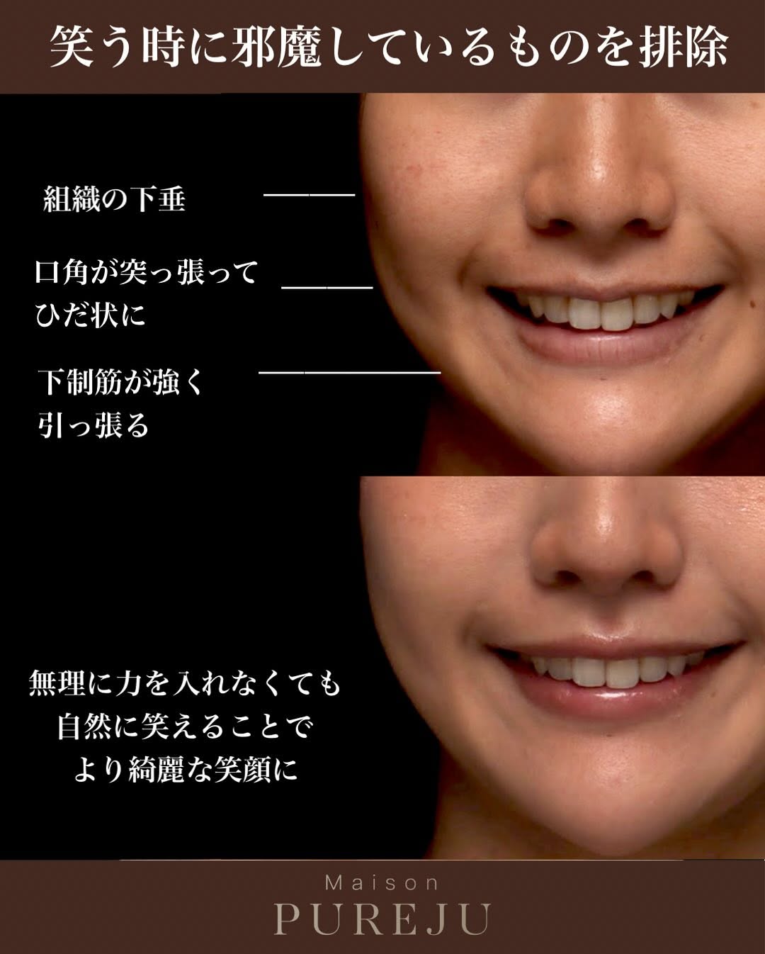 口角挙上＋糸リフトで笑い方の邪魔を取り除き上品な笑顔になった症例 画像2