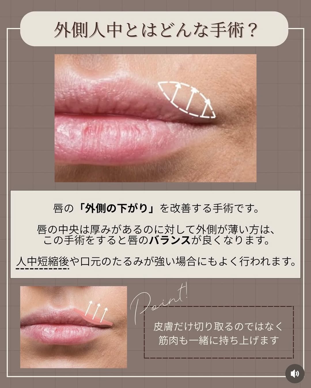 外側人中手術で唇のバランスを立体的に改善し口元の印象を整えた症例 画像4
