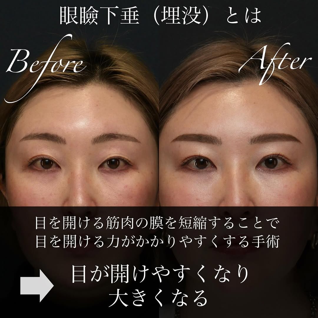 眼瞼下垂の切開法・埋没法の違いと手術の変化を解説した症例 画像2