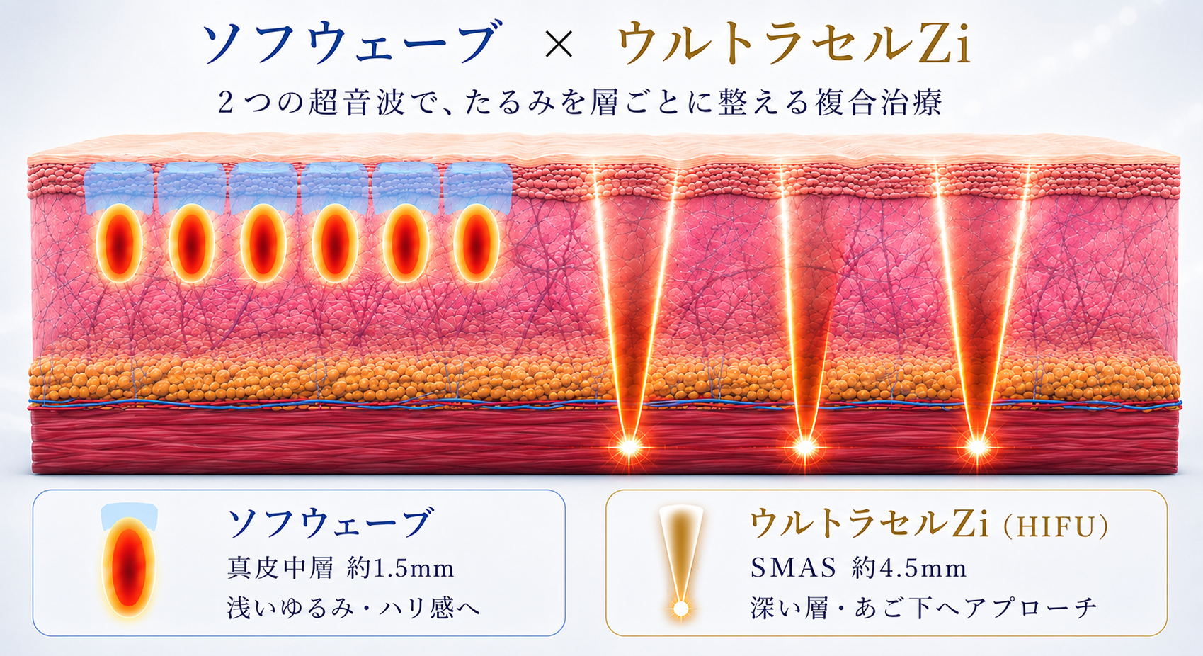 Ziウェーブリフト｜美容皮膚科｜Maison PUREJU 銀座｜Maison PUREJU