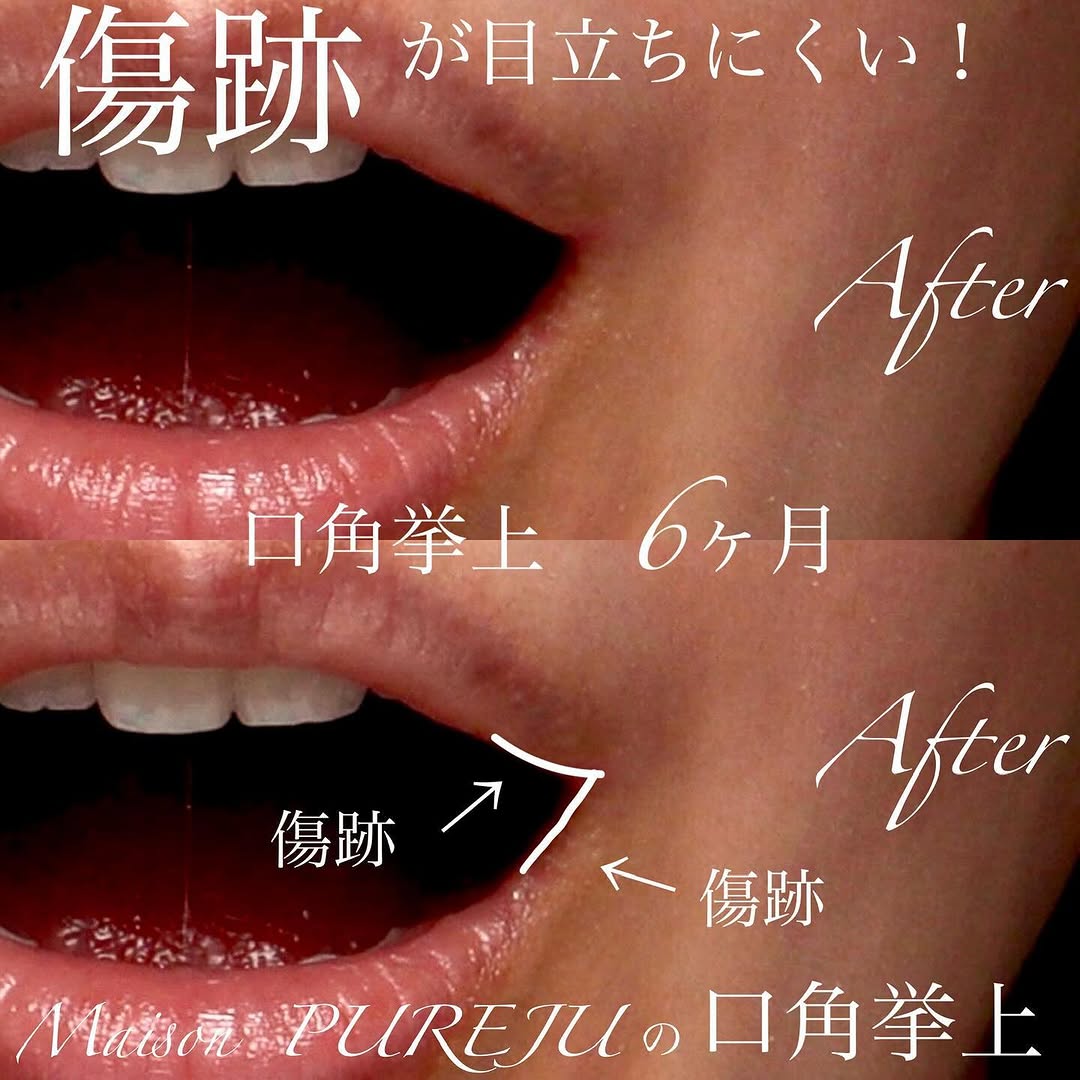 口角挙上の傷跡が目立ちにくい理由と口角形成の変化を示した症例