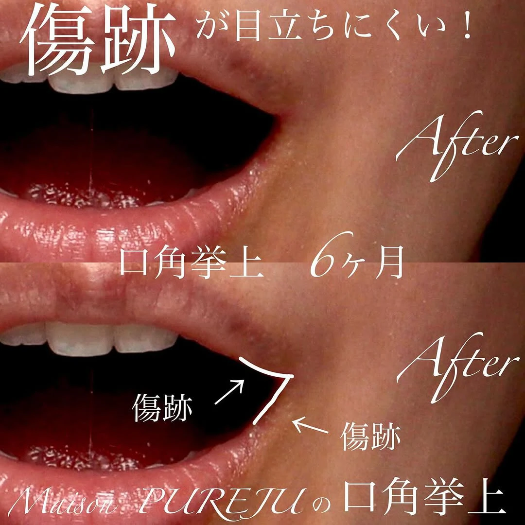 口角挙上の傷跡が目立ちにくい理由と口角形成の変化を示した症例