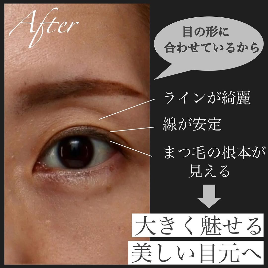 二重幅と自然な二重ラインを意識した二重埋没でまつ毛が上向きにきれいに出た症例 画像3