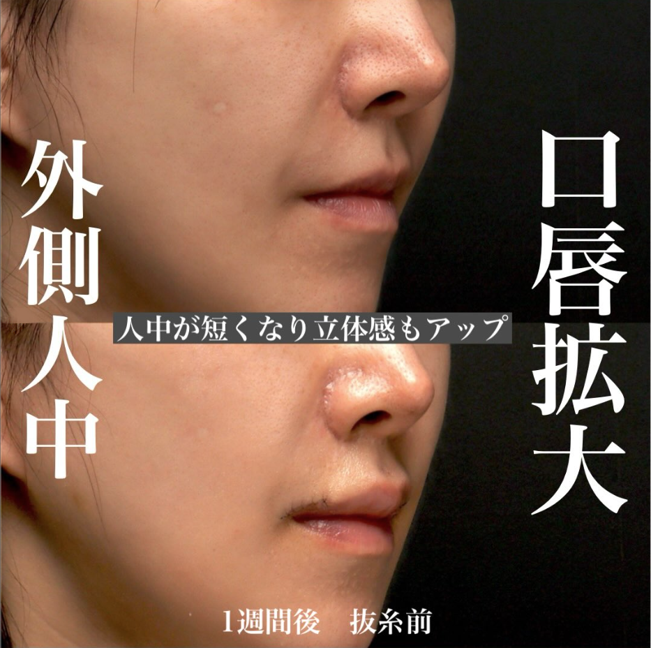 他院人中短縮後に口唇拡大＋外側人中短縮で人中を切らずに短く立体的に見せた症例（術後1週間〜1ヶ月の経過） 画像4