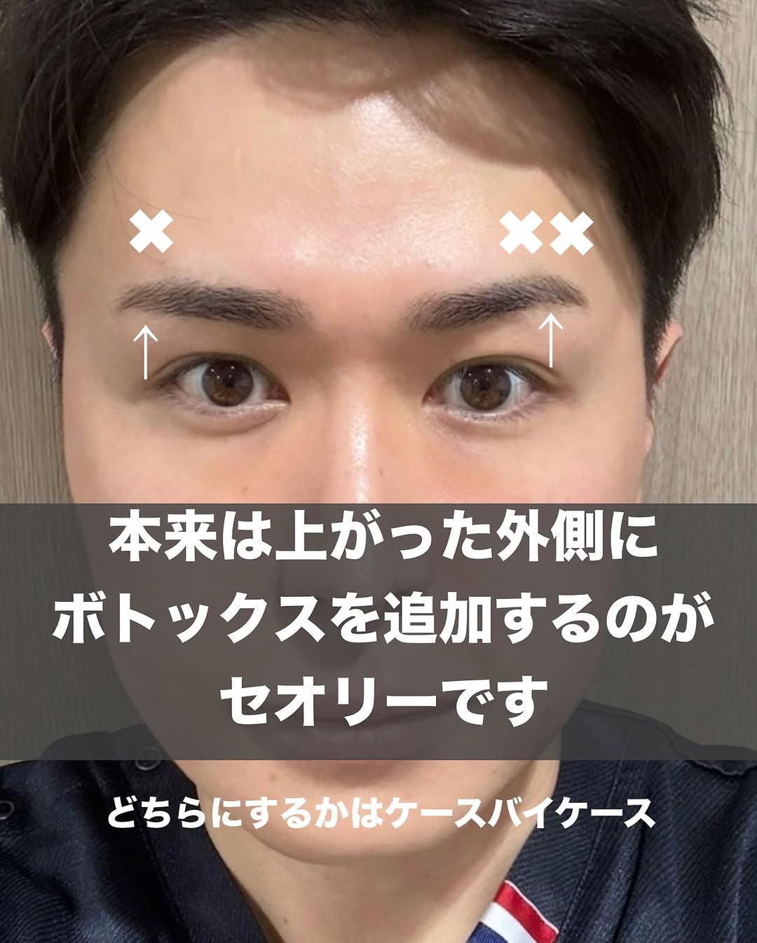 ボトックス後のスポックブローをオビソートで調整する方法 画像3