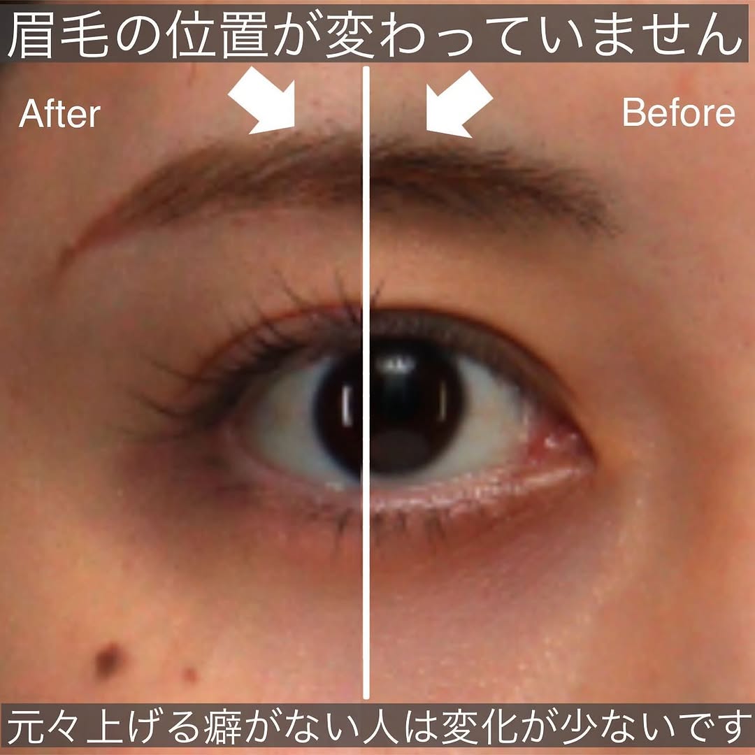 20代の眉下切開でまぶたの被さりを改善し本来の二重ラインを取り戻した症例 画像2