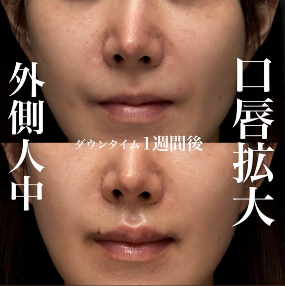 他院人中短縮後に口唇拡大＋外側人中短縮で人中を切らずに短く立体的に見せた症例（術後1週間〜1ヶ月の経過） 画像2