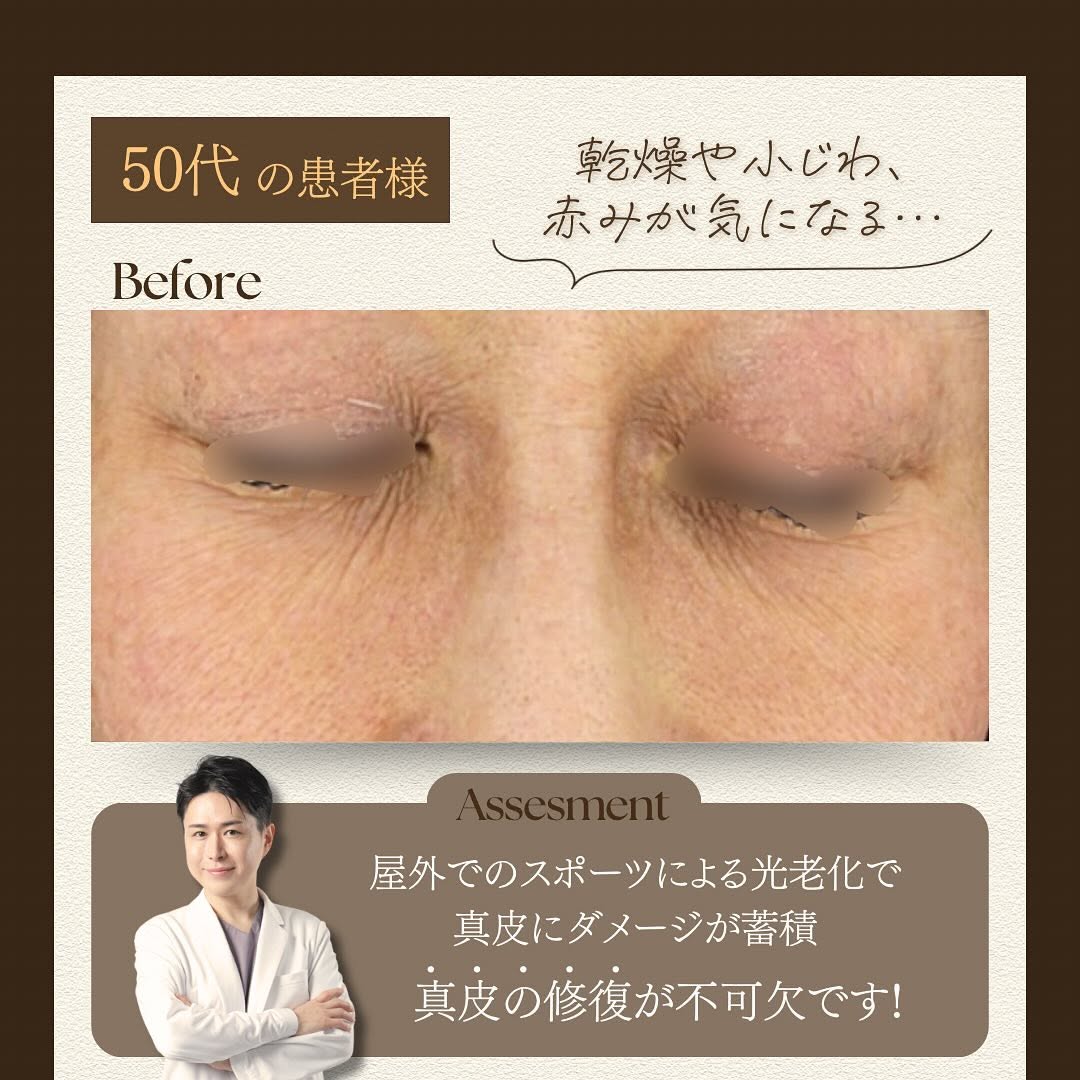 シルキー注射（スキンブースター）で光老化による真皮ダメージを根本から改善した症例 画像2