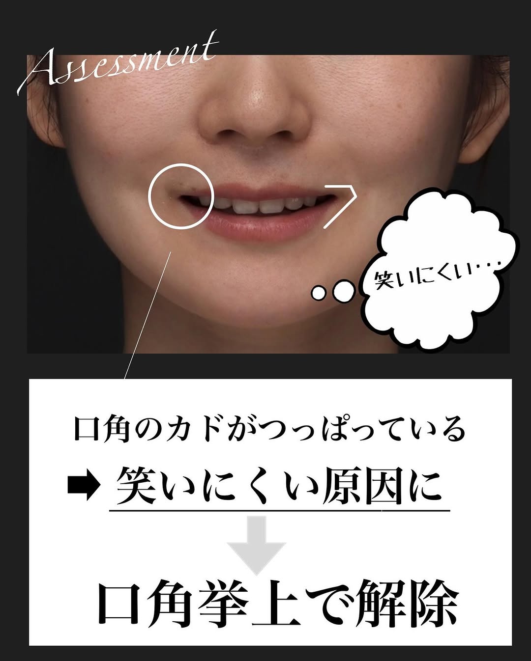 口角挙上＋ヒアルロン酸で術後6ヶ月笑顔が格段に良くなった症例 画像2