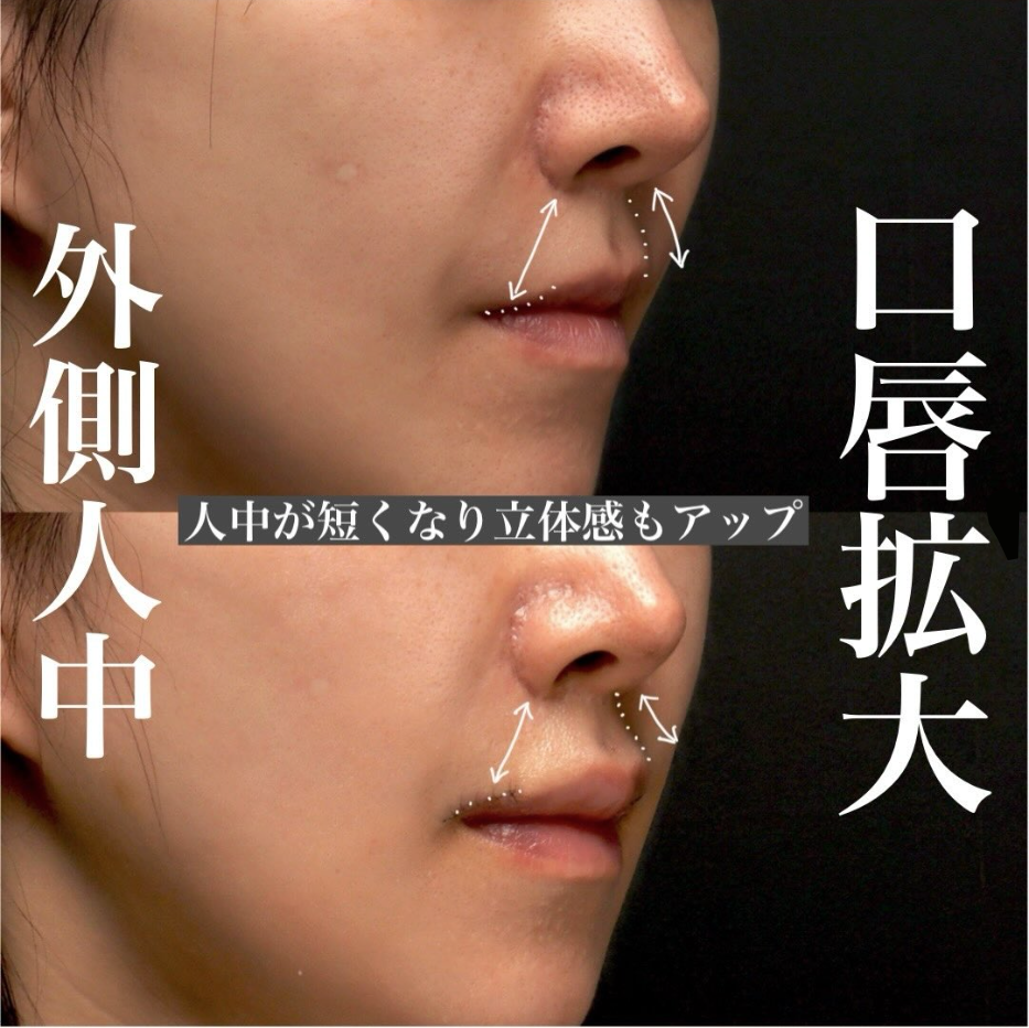 他院人中短縮後に口唇拡大＋外側人中短縮で人中を切らずに短く立体的に見せた症例（術後1週間〜1ヶ月の経過） 画像3