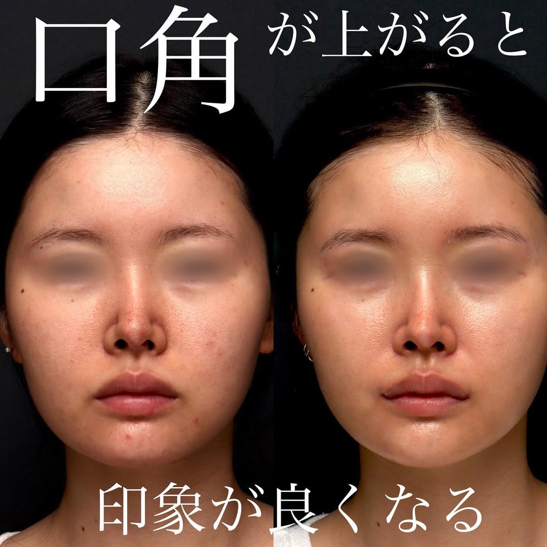 口角挙上でふとした瞬間の口角を上げ第一印象を改善した症例