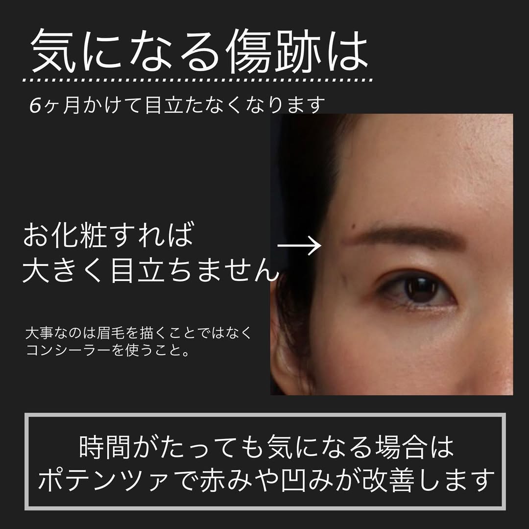 眉下切開＋二重埋没でたるみで隠れていた二重ラインをすっきり出した症例 画像5