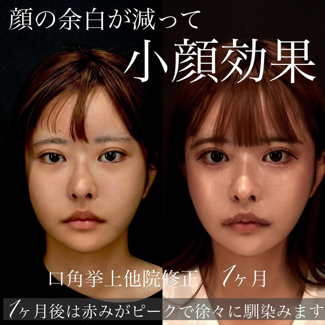 他院人中短縮後の口角挙上＋外側人中で唇全体のバランスを整えた症例 画像3