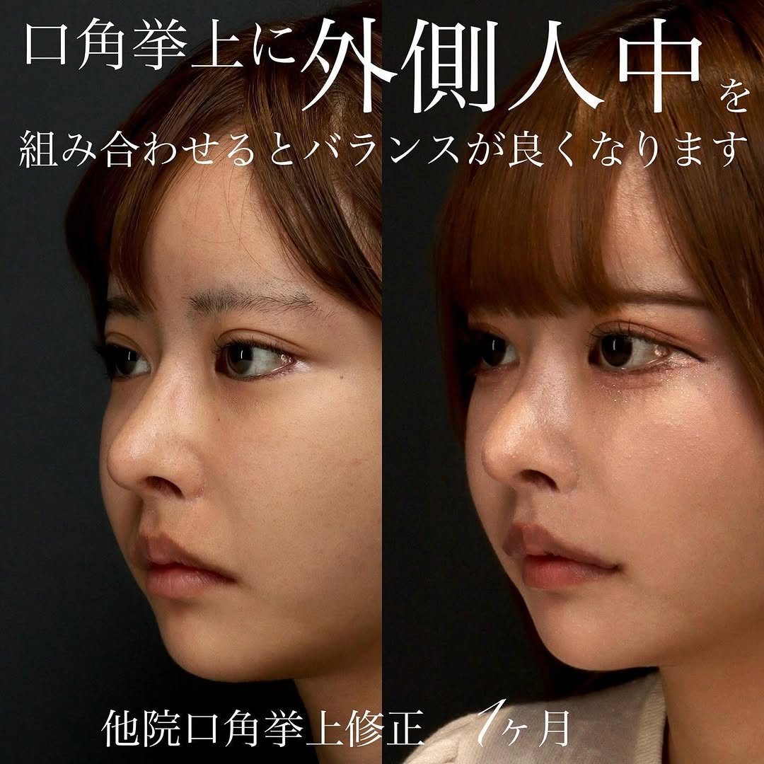 他院人中短縮後の口角挙上＋外側人中で唇全体のバランスを整えた症例
