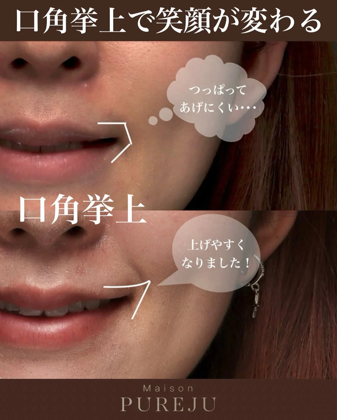 口角挙上で笑い方の悩みを解消し笑顔に自信が持てるようになった症例