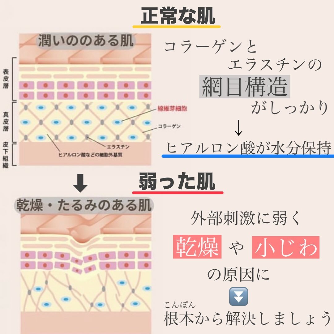 シルキー注射＋ジャルプロスーパーハイドロの肌育で目周りの小じわと乾燥を改善した症例 画像2