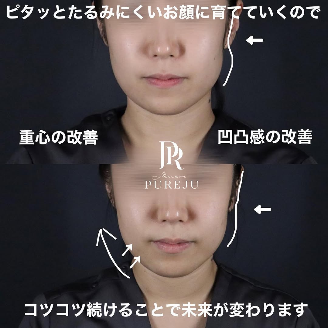 サーマジェン（RF）でフェイスラインを引き締めたるみを改善した症例 画像2
