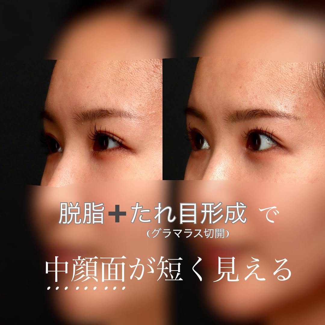 脱脂（くまとり）＋グラマラス（たれ目形成）で中顔面が短く見える丸い目元に整えた症例 画像2