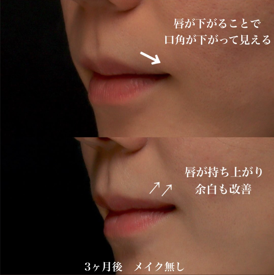 外側人中短縮で唇の下がりを改善し中顔面を短く見せた症例（術後3ヶ月・メイクなし） 画像2