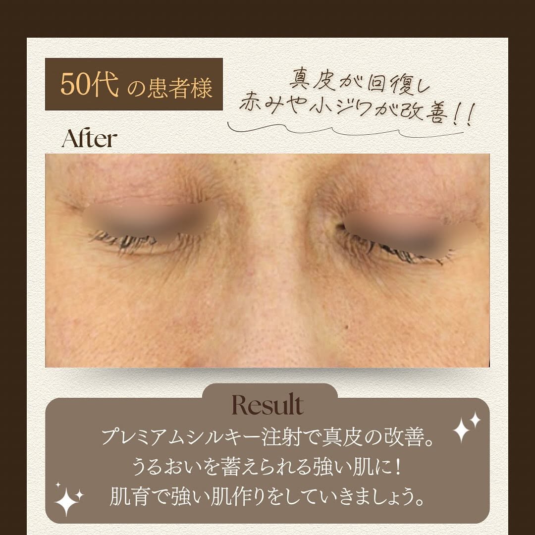 シルキー注射（スキンブースター）で光老化による真皮ダメージを根本から改善した症例 画像3