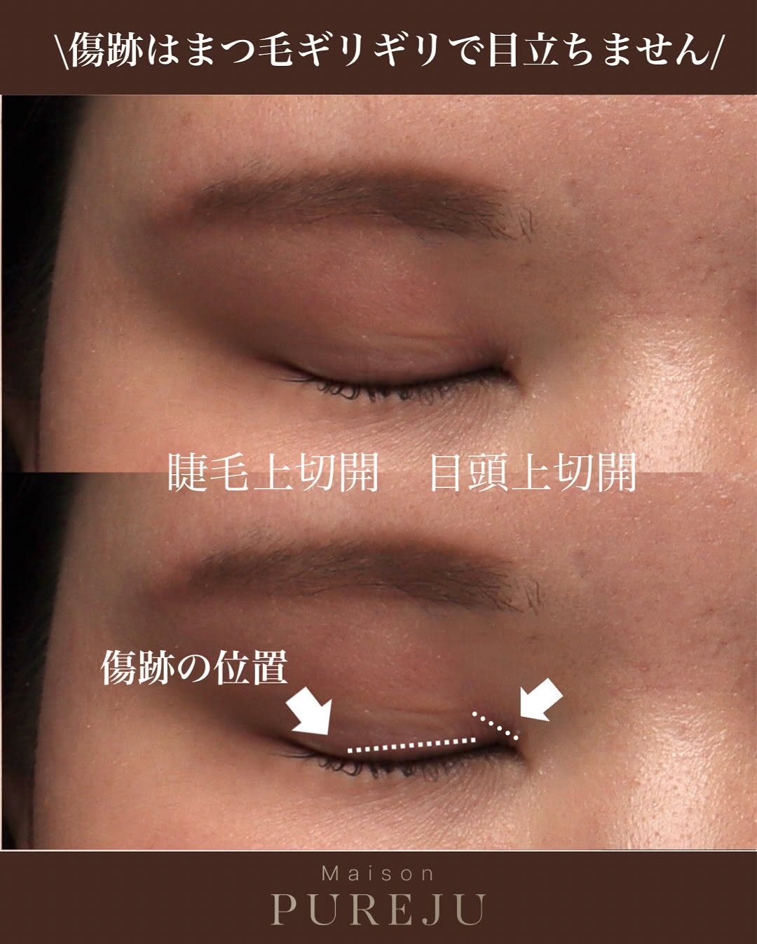 睫毛上切開でまつ毛と二重ラインの間のもたつきを改善しすっきりした目元にした症例 画像3