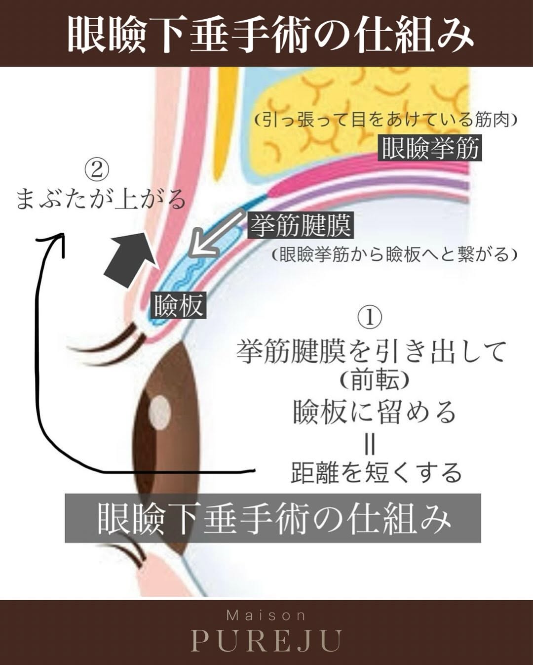 眼瞼下垂手術で隠れた黒目を見せ目の開きと印象を大きく改善した症例 画像3