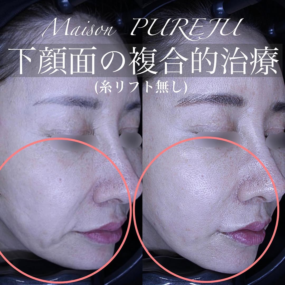 ジャルプロ＋ショートスレッド＋シルキー注射＋口角挙上の複合治療で口横のたるみを整えた症例