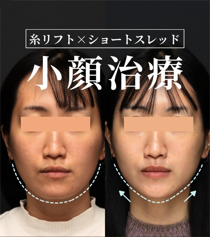 糸リフト＋ショートスレッド＋ヒアルロン酸で口元のゆるみと頬コケを整えた小顔治療の症例（2週間後）