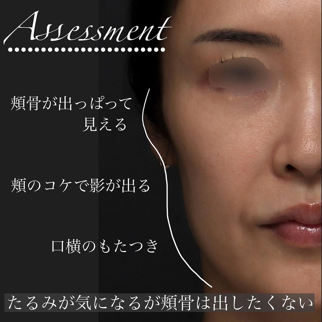 糸リフトの適材適所な使い分けでフェイスラインを自然に整えた症例 画像2