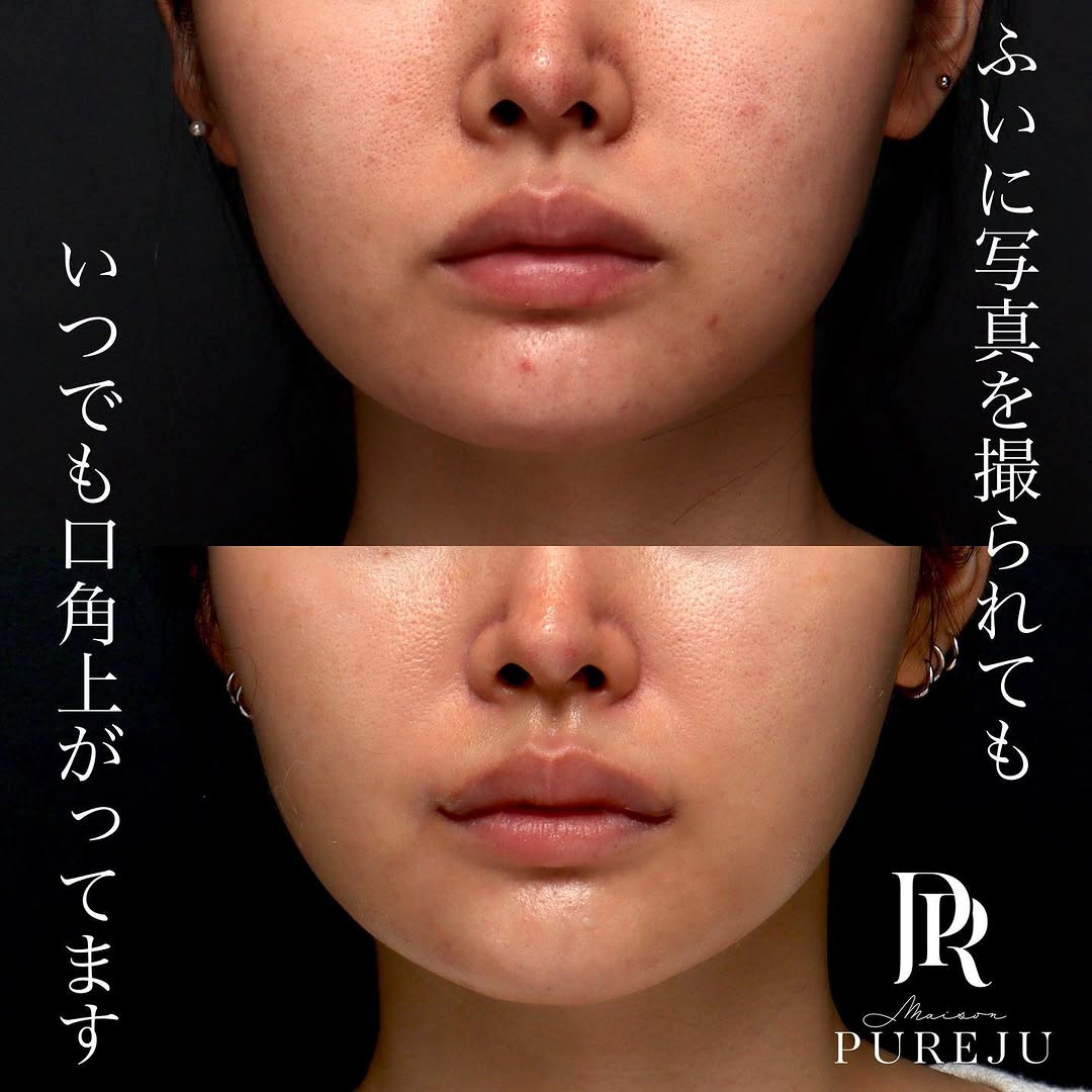 口角挙上でふとした瞬間の口角を上げ第一印象を改善した症例 画像3