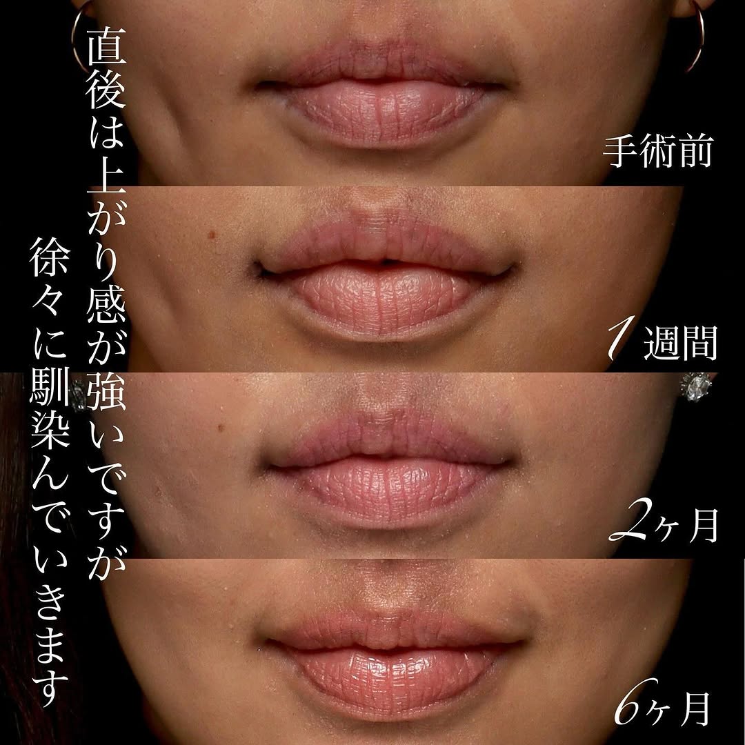 口角挙上でふとした瞬間も口角が下がらない印象の良い口元になった症例 画像2