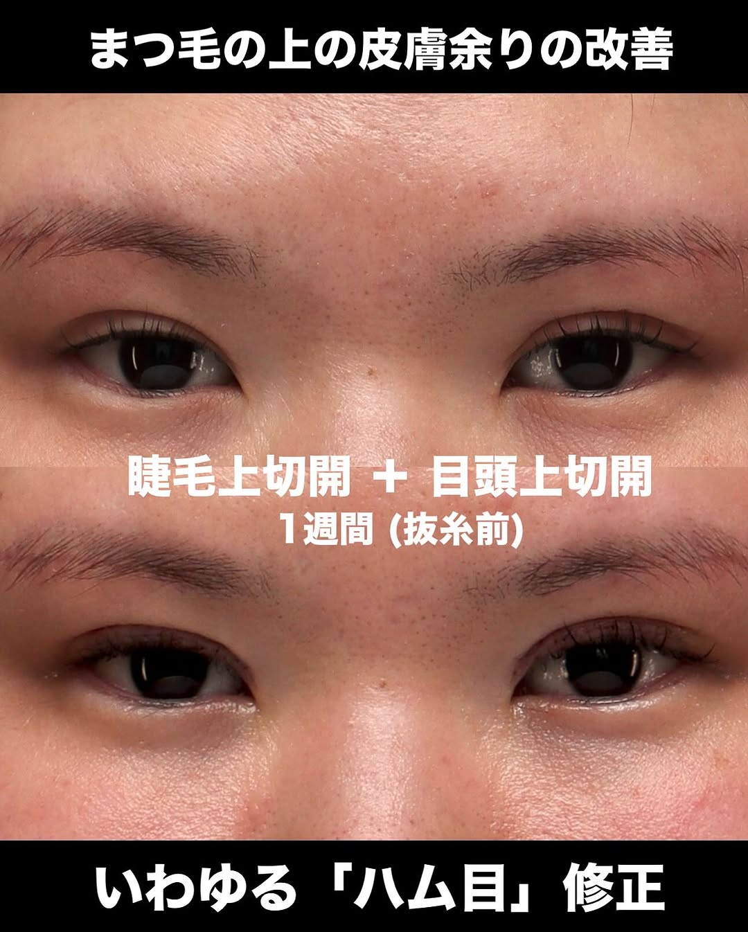 睫毛上切開＋目頭上切開でハム目を修正し綺麗な目元に整えた症例（術後1週間）