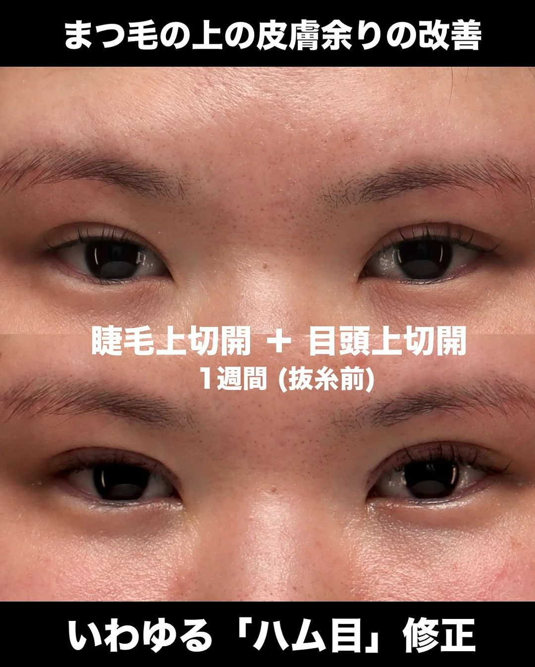 睫毛上切開+目頭上切開でハム目を修正し綺麗な目元に整えた症例(術後1週間)