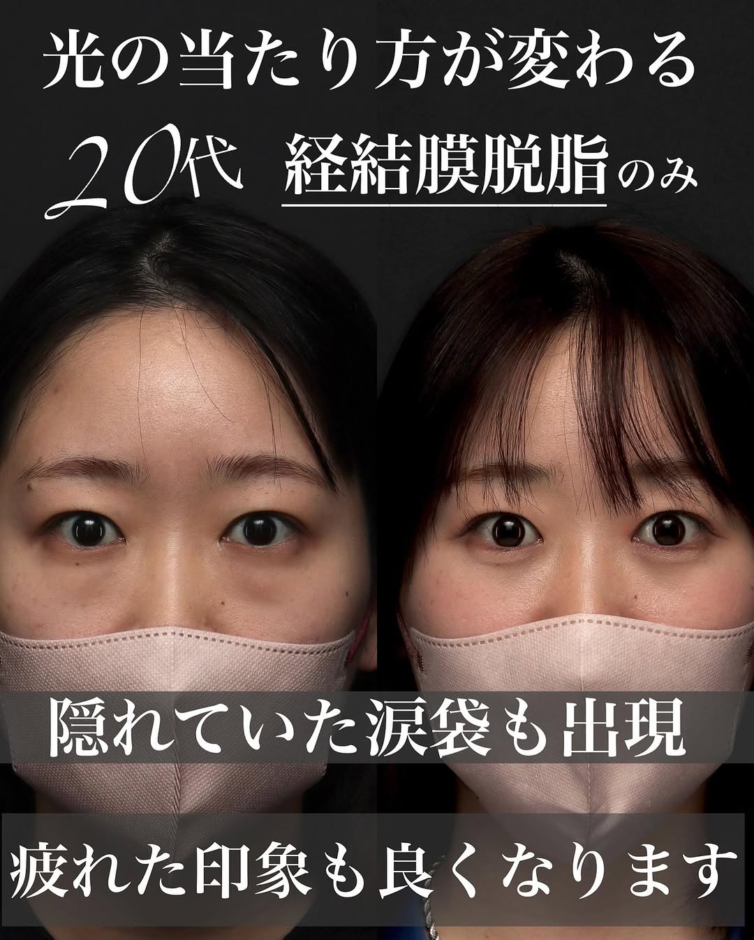 脱脂（経結膜脱脂）で目の下の膨らみを改善し明るく元気な印象になった症例 画像2