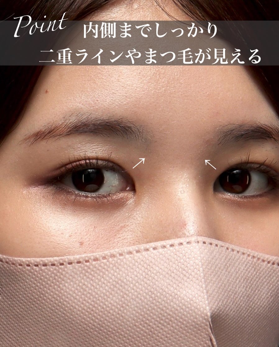 目頭上切開で目頭側のたるみを改善しどこから見てもすっきりした丸い目元に整えた症例 画像3