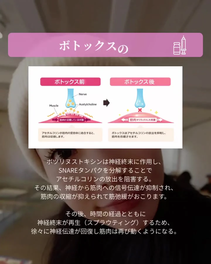 ボツリヌストキシン製剤の選び方。たかがボトックス、されどボトックス