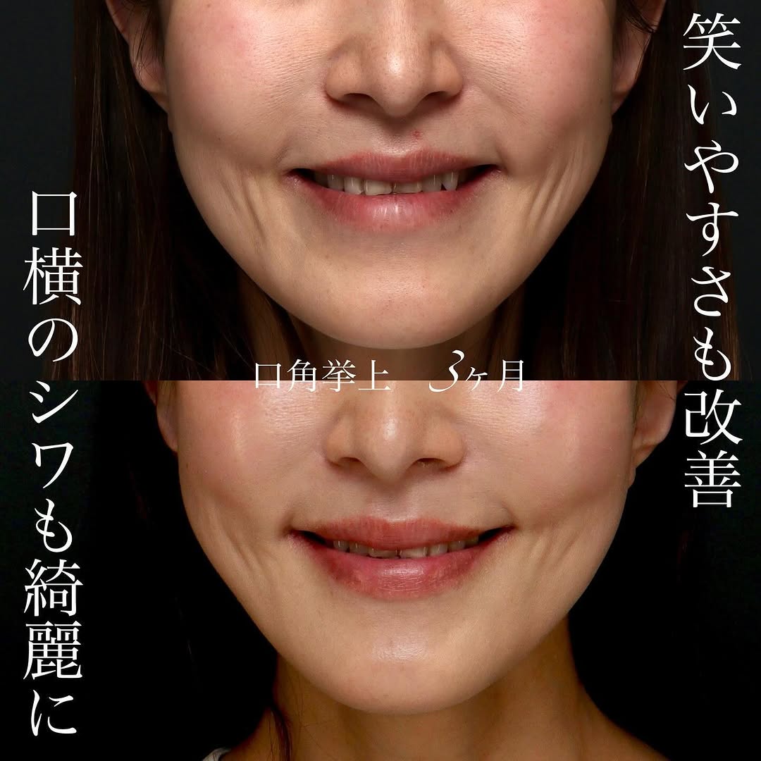 40代の口角挙上でほほえんだ口元の上品な印象を整えた症例 画像2