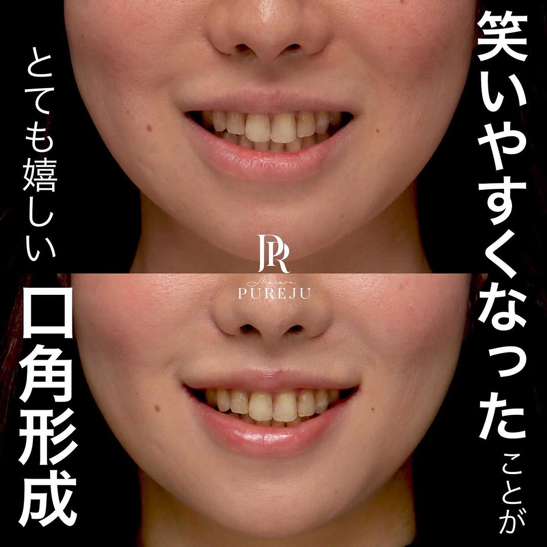 口角挙上で笑いやすさと口角の上がりを同時に改善した症例 画像2