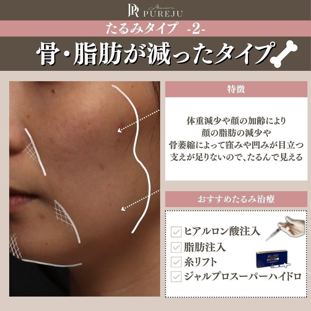 あなたのたるみはどのタイプ？原因3タイプ別おすすめ治療を医師が解説 画像4