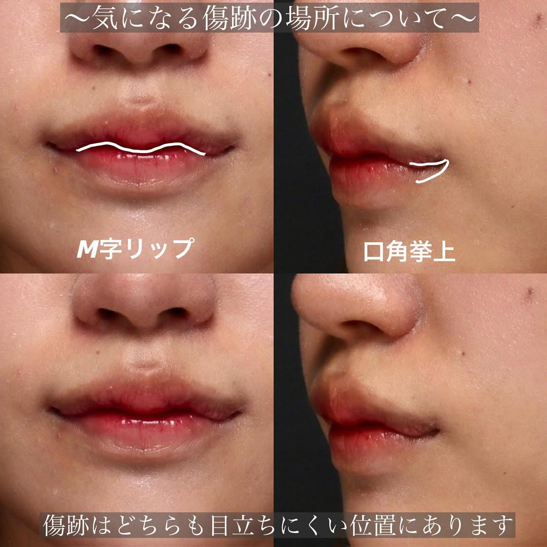 M字リップ×口角挙上でいつ撮られても口角が上がった口元に（術後1ヶ月） 画像3