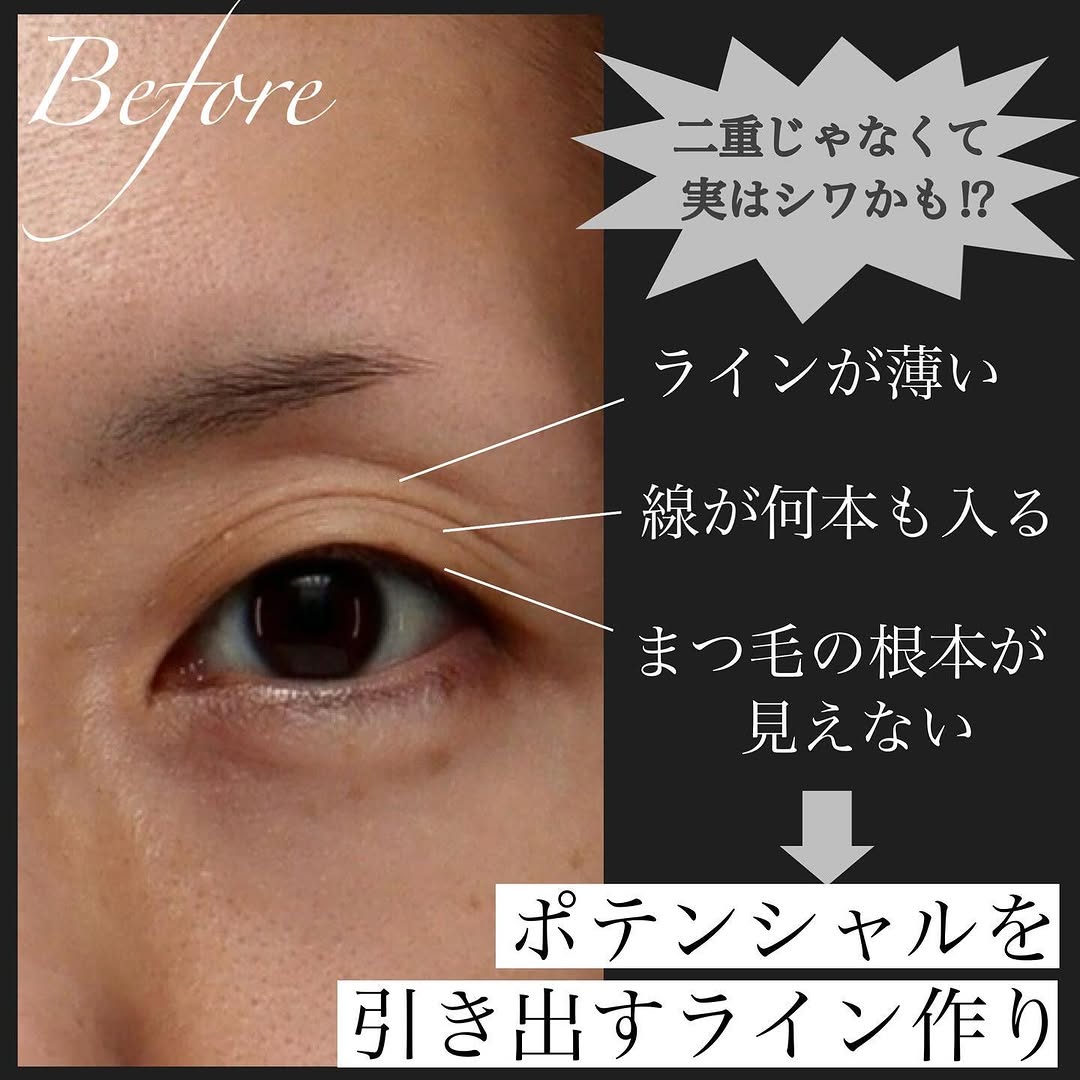 二重幅と自然な二重ラインを意識した二重埋没でまつ毛が上向きにきれいに出た症例 画像2