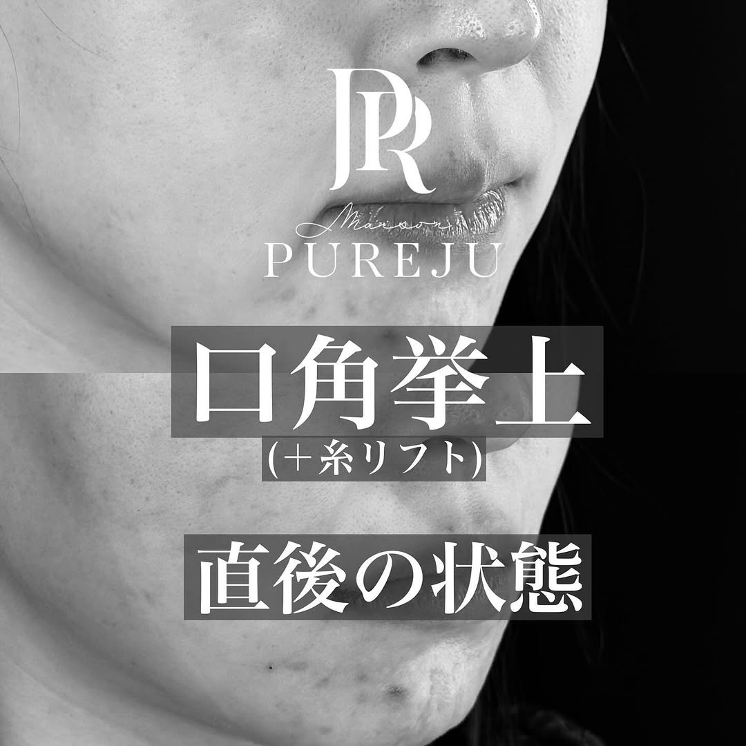 口角挙上＋糸リフトの直後ダウンタイム経過を示した症例