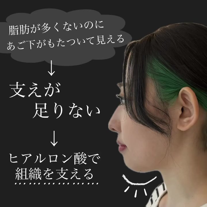 あごのヒアルロン酸で輪郭のバランスを自然に整えた症例 画像3
