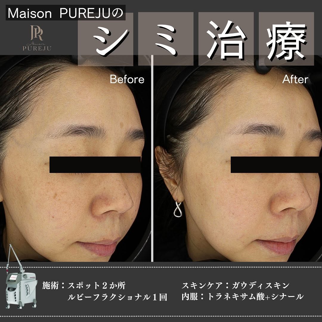 シミ治療の3ステップ｜プレ・照射・アフターケアまで一貫して行うMaison PUREJUのアプローチ