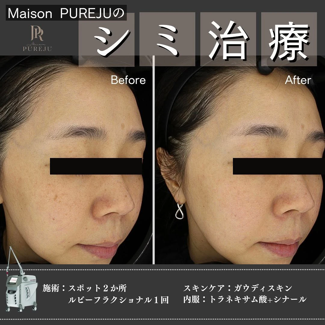シミ治療の3ステップ|プレ・照射・アフターケアまで一貫して行うMaison PUREJUのアプローチ